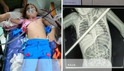 فريق طبي بمستشفيات بنها الجامعية ينقذ طفلة بعد اختراق صدرها سيخ حديدي