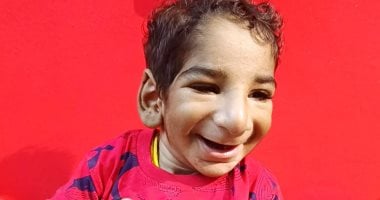 ملاك صغير بملامح كبيرة.. رحلة أنس مع مرض نادر بدأت بصدمة الولادة وانتهت برسالة ضد التنمر.. والدة أنس: شخّصوا ابنى بـ«الشيخوخة المبكرة» ثم اكتشفنا أن التشخيص خاطئ.. وتحليل جينى بـ60 ألف جنيه لدفع رحلة العلاج