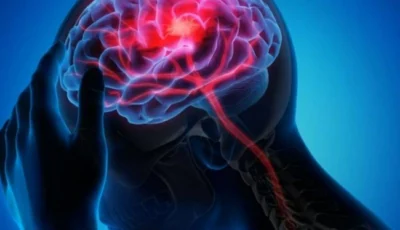 «خريطة دماغية» لعلاج الصرع بدقة