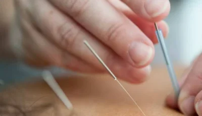 الوخز بالإبر يسبب كارثة بقدم امرأة